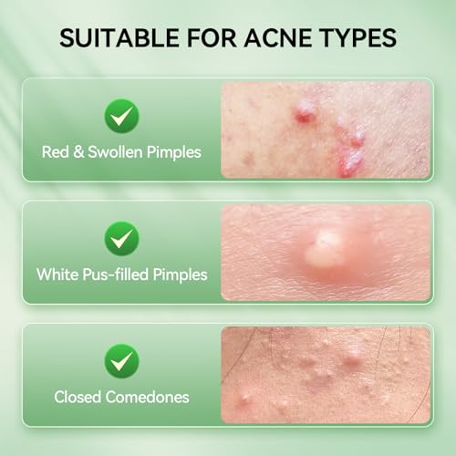 LANBENA 2% Salicylic Acid Acne Spot Treatment Drying Lotion, 0.42 Fl Oz 0.42Fl Oz-18% ZINC OXIDE Acne Dryig Lotion
