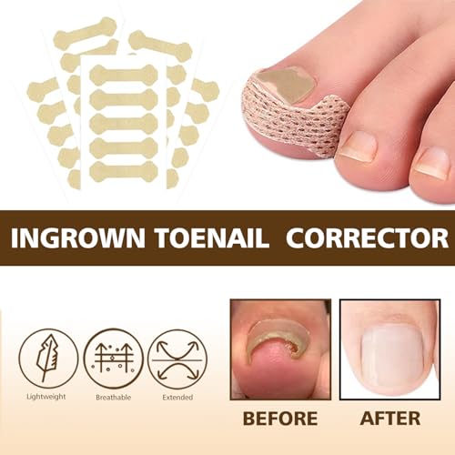 Ingrown Toenail Corrector Set with Magnifier and Correction Strips, Professional Ingrown Toenail Treatment Tools Set, Safe and Effective Nail Care for Home Use 1