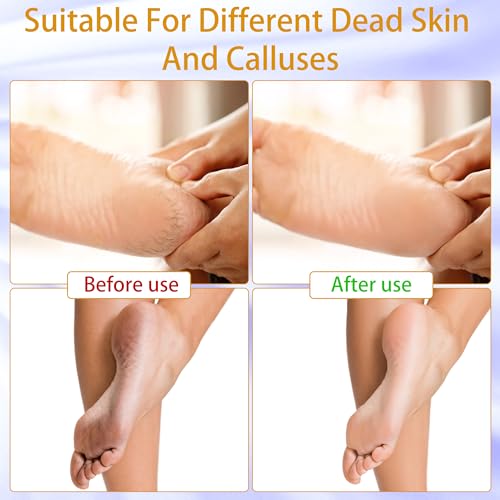 Electric Callus Remover - 9 speeds, Foot Sander with Replacement Sandpaper Discs, Rechargeable Unisex Pedicure and Manicure Tool for Dead, Dry, chapped Skin and calluses