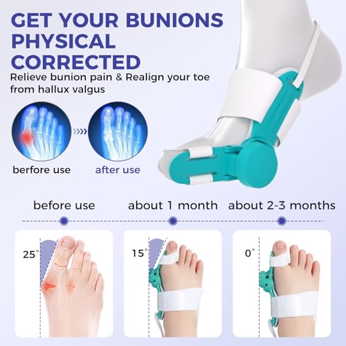 Bunion Corrector for Women & Men, Adjustable Knob Big Toe Splint,Orthopedic Brace for Hallux Valgus Correction, Toe Alignment & Pain Relief, Fits Left & Right Feet (Day & Night Wear,1PCS) Blue 1