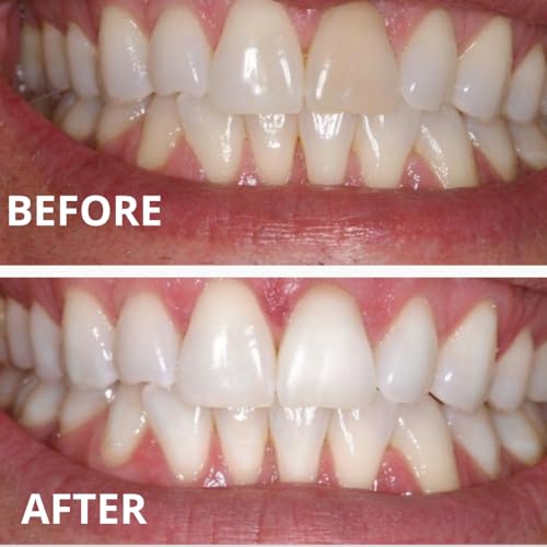 16% Carbamide Peroxide Teeth Whitening Gel – Sensitive Teeth Formula – Made in USA – Professional Refill Syringes (4 x 3cc) for Use with Whitening Trays
