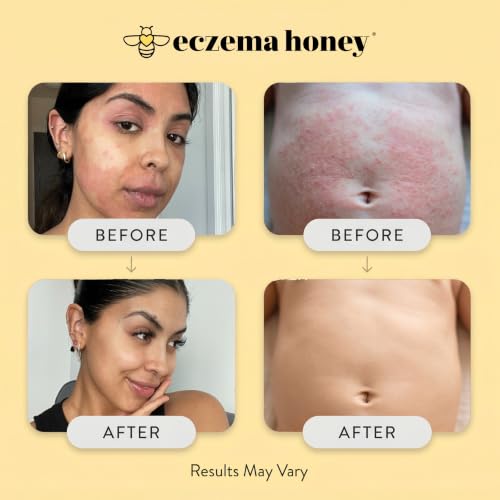 ECZEMA HONEY Original Skin-Soothing Cream for Dry Itchy Skin (4 Oz)