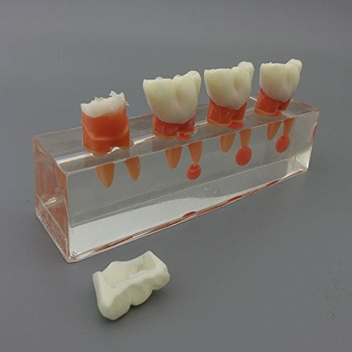 Dental Teeth Model 4-Stage Endodontic Treatment Model for Studying and Teaching …