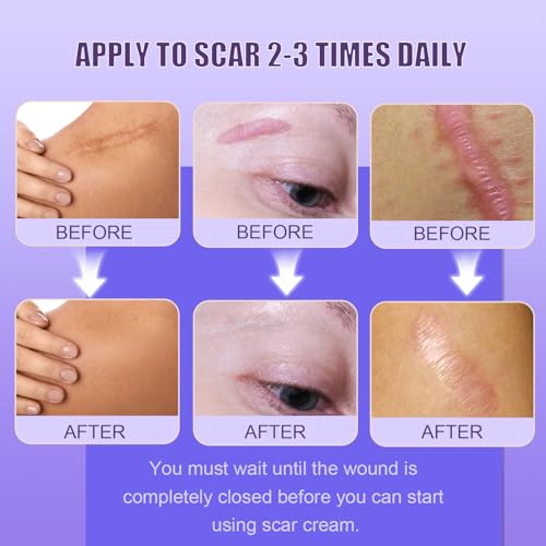 Silicone Scar Cream Scar Gel - Advanced Scar Removal Cream for Surgical Scars, Stretch Marks, Acne, C-Section, Keloids, Old & New Scars Scar Treatment from Body & Face, 35g (1.23Oz) Large