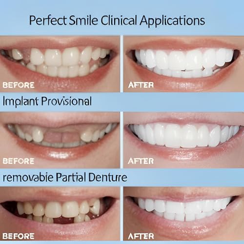 2 Pairs of Smile Adjustable Supports Unisex for Temporary Use to Quickly Restore Self-Confident Smiles