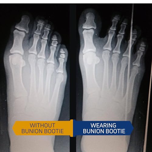 Bunion Big Toe Corrector - Medium Right + Bunion Balm Night