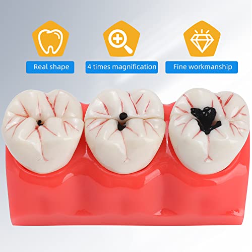 Dental Caries Teeth Model - 4 Times Removable Dental Tooth Decay Model Dental Caries Evolution Model Tooth Pathology Display Model