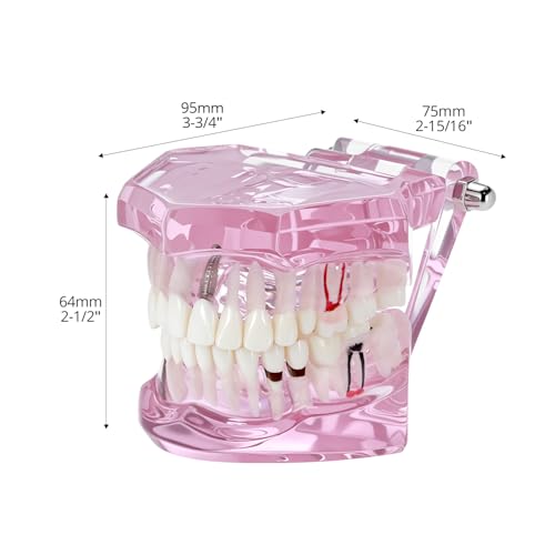 QWORK Dental Implant Teeth Model #2001 Typodont Restoration Pink – Detailed Fixed Prosthetic Study Aid for Dental School Education, Patient Consultation & Training