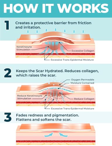 Medical Grade Silicone Scar Tape - 1.6"x70" - Effective Scar Removal 70"x1.6" Beige