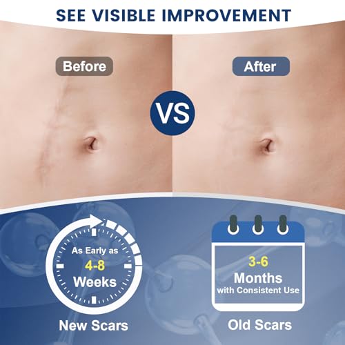 Rvlaim 100% Advanced Silicone Scar Gel for Old & New Scars,1.7oz/50ml