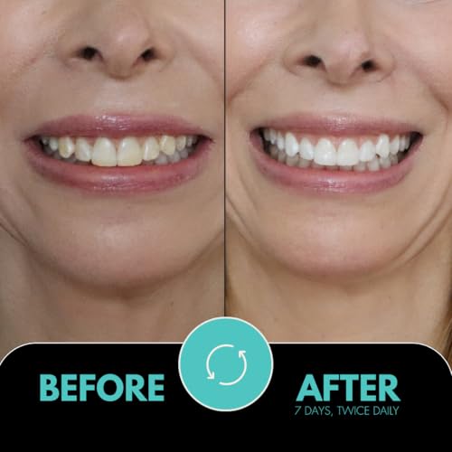 IntelliWHiTE ProStrips Teeth Whitening Strips, 14 Day Treatment, Whitens Up to 12 Shades, Enamel-Safe Gentle Remineralizing Formula, Dentist Formulated for Sensitive Teeth, (28pk Coconut Flavor) 1 Count (Pack of 28)