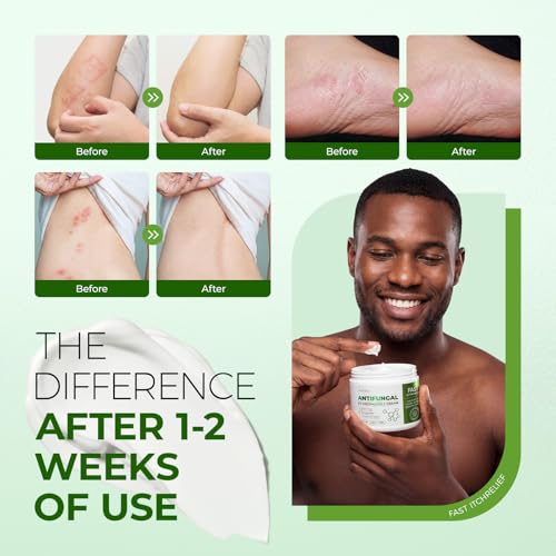 Inlifay 2% Miconazole Antifungal Cream: Helps Relieve the itching, Burning, Cracking, and Scaling associated with fungal infections Such as Athlete's Foot,Jock Itch, and Ringworm(3.51 OZ) 3.51 Ounces