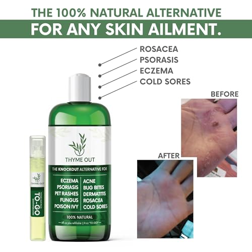 All Natural Eczema Treatment- Psoriasis Treatment - an All-in-One Solution for Acne, Dermatitis, Rosacea, Cold Sores, Pet Rashes, Bug Bites, and Poison Ivy - Anti-Itch Spray for Itchy Skin Relief Original 2 Piece Set (8 Fl Oz total)
