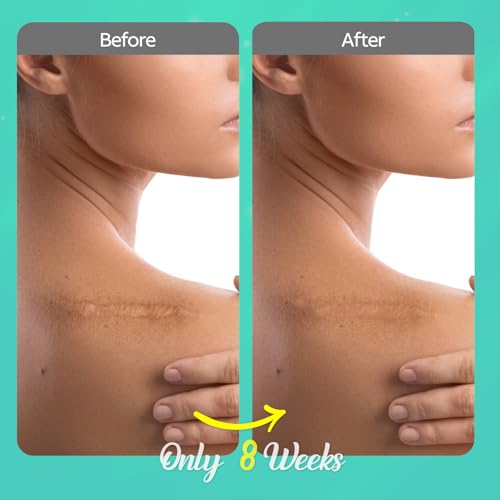 Scar Cream for Keloid Bump Removal: Professional Silicone Gel for Keloids, Acne Scars, Stretch Marks, C-Section & Burn Marks – Old & New Scar Care Treatment, 1 oz 30g(Pack of 1)