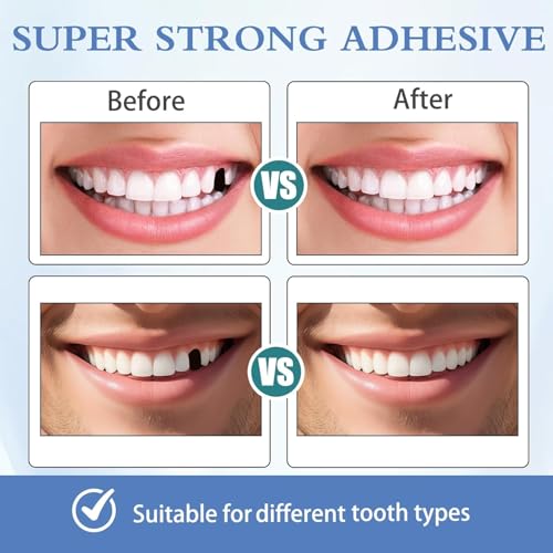 Tooth Repair Kit 12PCS, Temporary Natural Shade for Filling Broken Tooth