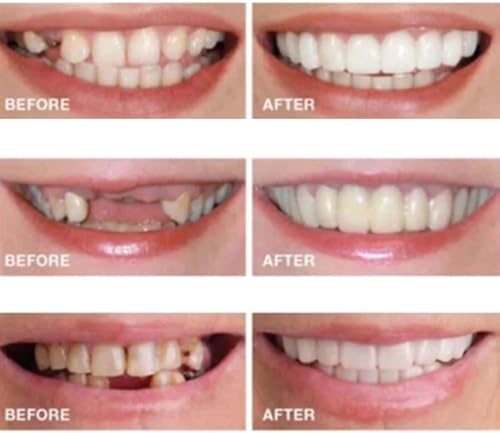 2 Pairs, Regain Confidence Smile Temporarily Adjustablefor Women and Men, Top and Bottom(White)