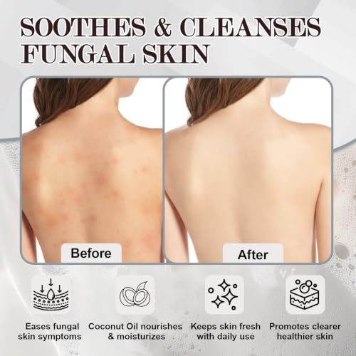 Antifungal Soap - Body & Face Wash for Acne, Folliculitis, Eczema, Body Odor, Jock Itch, Athletes Foot, Tinea Versicolor with Tea Tree Oil & Coconut (3Bars x 2.82 oz)