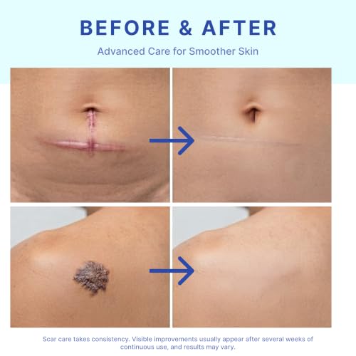 Suquato Silicone Scar Stick – Silicone Keloid Scar Removal Cream for Face & Body, Helps Improve Surgical Scars, C-Section, Acne Scars & Stretch Marks, Portable Twist Stick– 20g
