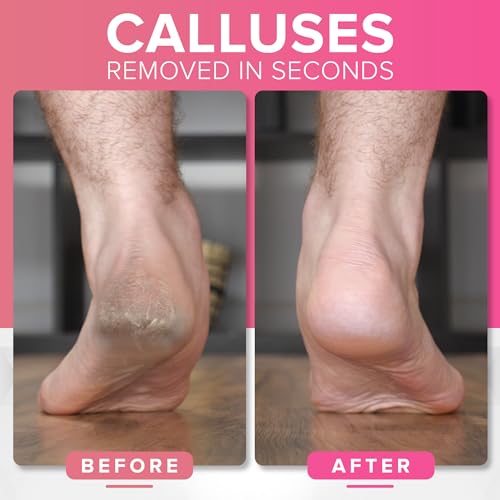 NYK1 RUSTPROOF Foot File Callus Remover for Feet | Pink Pink Megafile
