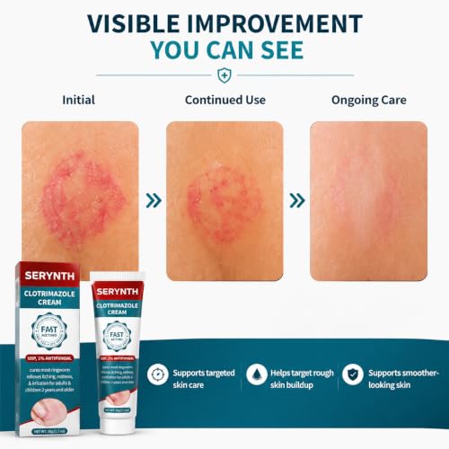 Antifungal Cream Clotrimazole 1%, Athlete's Foot & Ringworm Care, 30g