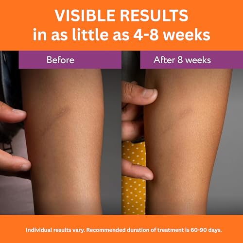 Abera Scar Cream - Advanced Nano Formula for New and Old Scars - Effective for Keloids, Stretch Marks, Surgical Scars, and Acne Marks - Restores Smooth-Looking Skin (1 Box) 1 Box