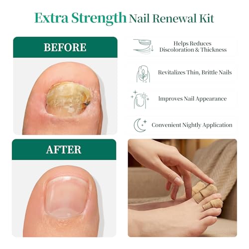 APUREE Fungal Nail Patches Extra Strength: 1% Tolnaftate Nail Repair 32PCS