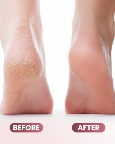 Electric Foot Callus Remover with Ice Compress, 50 Sanding Discs