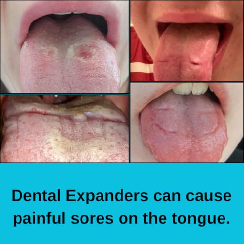 RPE Tongue Guard: Prevents and Helps Heal Tongue Sores Caused by Dental Expanders | Tongue Sores | Metal Cuts | Dental Ortho Braces |