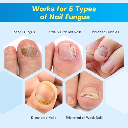 Nail Fungus Treatment Pen for Damaged Nails-Contains 25% Undecenoic Acid, Tea Tree Oils, along with Other Natural Ingredients, Mild and Non-Toenail Fungus Treatment Extra Strength 4pcs