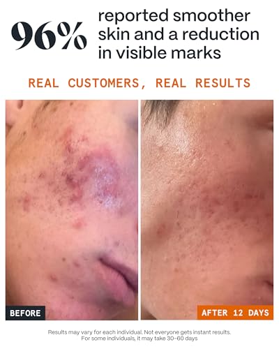 Norse Organics Pimple Scars Balm 2.0 (1 oz)