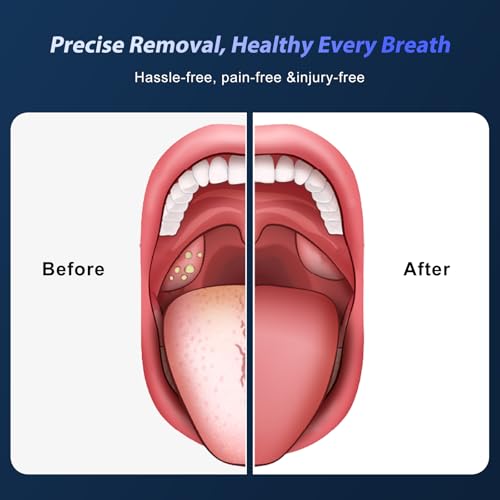 Electric Tonsil Stone Remover Vacuum USB Rechargeable, 6 Suction Levels for Bad Breath Relief, Painless Tonsillolith Removal Kit, LED Light, 11-in-1 Glass & Silicone Probes White