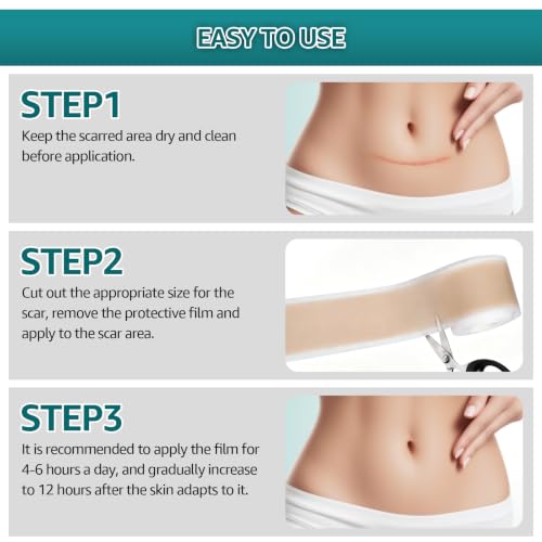 Silicone Scar Sheets, Silicone Scar Tape for Surgical, Hypertrophic, Keloid, C-Section, Burn, Old & New Scars, Reusable Scars Removal Sheets
