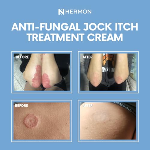 Hermon Jock Itch Cream: Ringworm Treatment for Humans, Athlete's Foot Cream -Fast and Effective Symptom Relief of Itching, Burning and Redness -100ml 1 Pack Cream