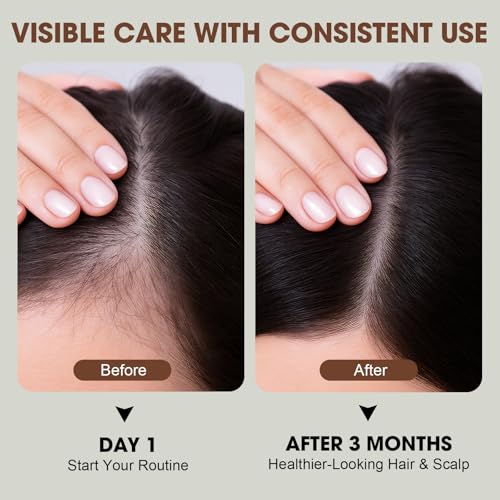 PP405 Hair Treatment Scalp Serum with Ginger & Rosemary Oil, Non-Greasy