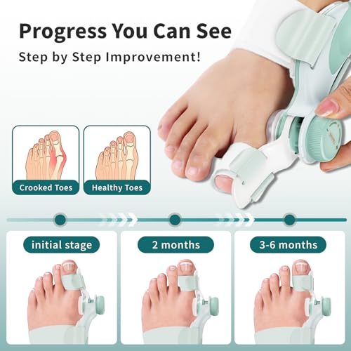 Bunion Corrector for Women Big Toe - US Patent 3 Precision Angles (0°/7.5°/15°) Adjustable Toe Straightener & Bunion Splint Brace with Extra Straps & Toe Separator, Fits Left & Right Foot, Medium, Pink 1 PCS