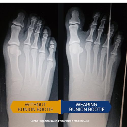 Bunion Big Toe Corrector - Medium Right + Bunion Balm Day