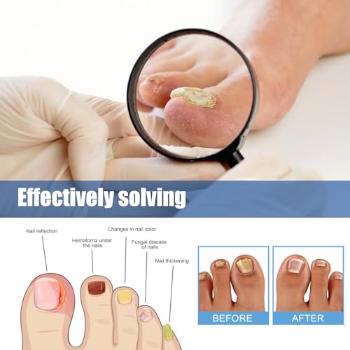 Fungal Nail Patches 60 Pcs,Upgraded Toe Nail Fungus Treatments 60 Count (Pack of 1)