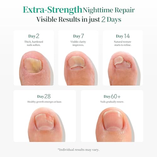 APUREE Fungal Nail Patches Extra Strength: 1% Tolnaftate Nail Repair 32PCS