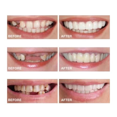 2 Pairs,Temporary Smile Solution, Adjustable & Comfortable.(White) (6) 6