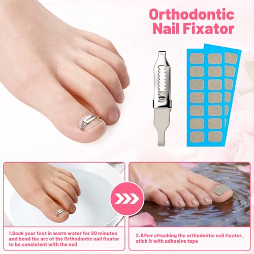 Ingrown Toenail Removal Kit Professional Ingrown Toenail Tool Kit with Ingrown Toenail Corrector, Corrector Patches, Toenail Clipper, Tools Stainless Steel Pedicure Tool Set