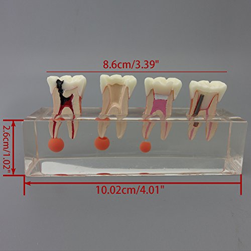 Dental Teeth Model 4-Stage Endodontic Treatment Model for Studying and Teaching …