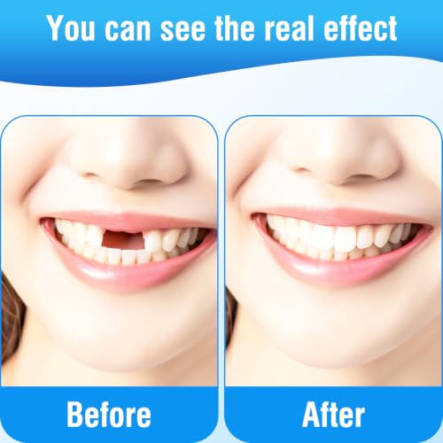 EXCEART 100 Pieces Artificial Resin Teeth Veneer Fillings - Temporary Replacements for Tooth Repair Supply