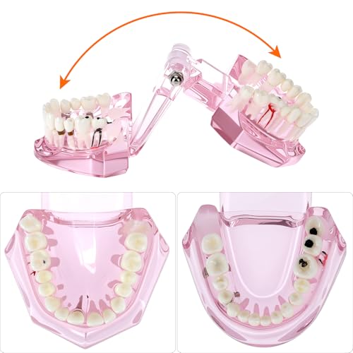 QWORK Dental Implant Teeth Model #2001 Typodont Restoration Pink – Detailed Fixed Prosthetic Study Aid for Dental School Education, Patient Consultation & Training