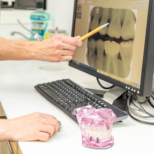 QWORK Dental Implant Teeth Model #2001 Typodont Restoration Pink – Detailed Fixed Prosthetic Study Aid for Dental School Education, Patient Consultation & Training