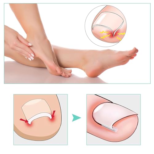 50 Pcs Ingrown Toenail Corrector Set, Toenail Correction Strips Brace Kit, Ingrown Toenails Correction Pad Recover Clips, Toenails Straightener Strips for Women Men's Nail Treatment Pedicure