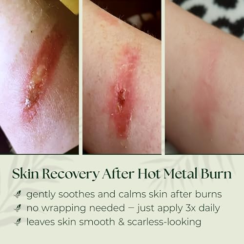 SCARLESS SKIN RECOVERY NATURAL FIRST AID GEL for Burns & Wounds First Aid Gel for Cuts, Scrapes & Burns – Advanced Skin Repair Ointment Soothing Film-Forming Barrier – Fragrance-Free