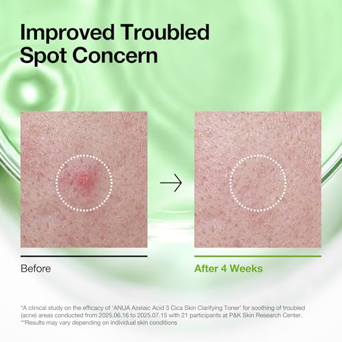 Anua Azelaic Acid 3 CICA Clarifying Toner, 8.45 fl.oz 8.45 Fl Oz (Pack of 1)