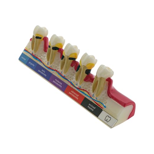 Dental Model 6-Stage Periodontal Disease Demonstration Model