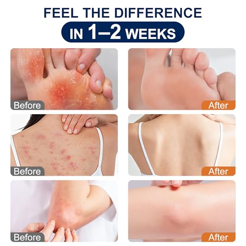 Antifungal Cream for Jock Itch, Athletes Foot & Ringworm - 2% Miconazole Nitrate Cream for Humans Skin Fungus, Relieves Itching, Burning, Cracking and Scaling (3.5 Ounce) 3.5 Ounce