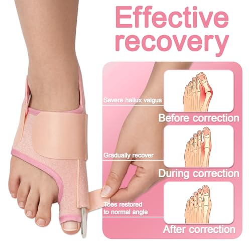 SPRING SEAON 2-Pack Bunion Corrector Adjustable Toe Splint Day/Night Pink